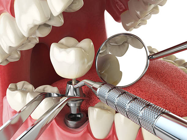 Best Emergency Cosmetic Dentistry (e.g., broken veneers) in Highland, CA